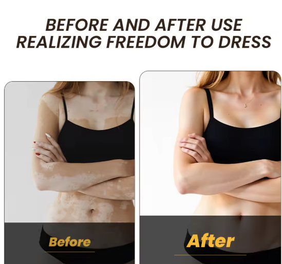 Sumifun - Vitamine Vitiligo Cream (Original)