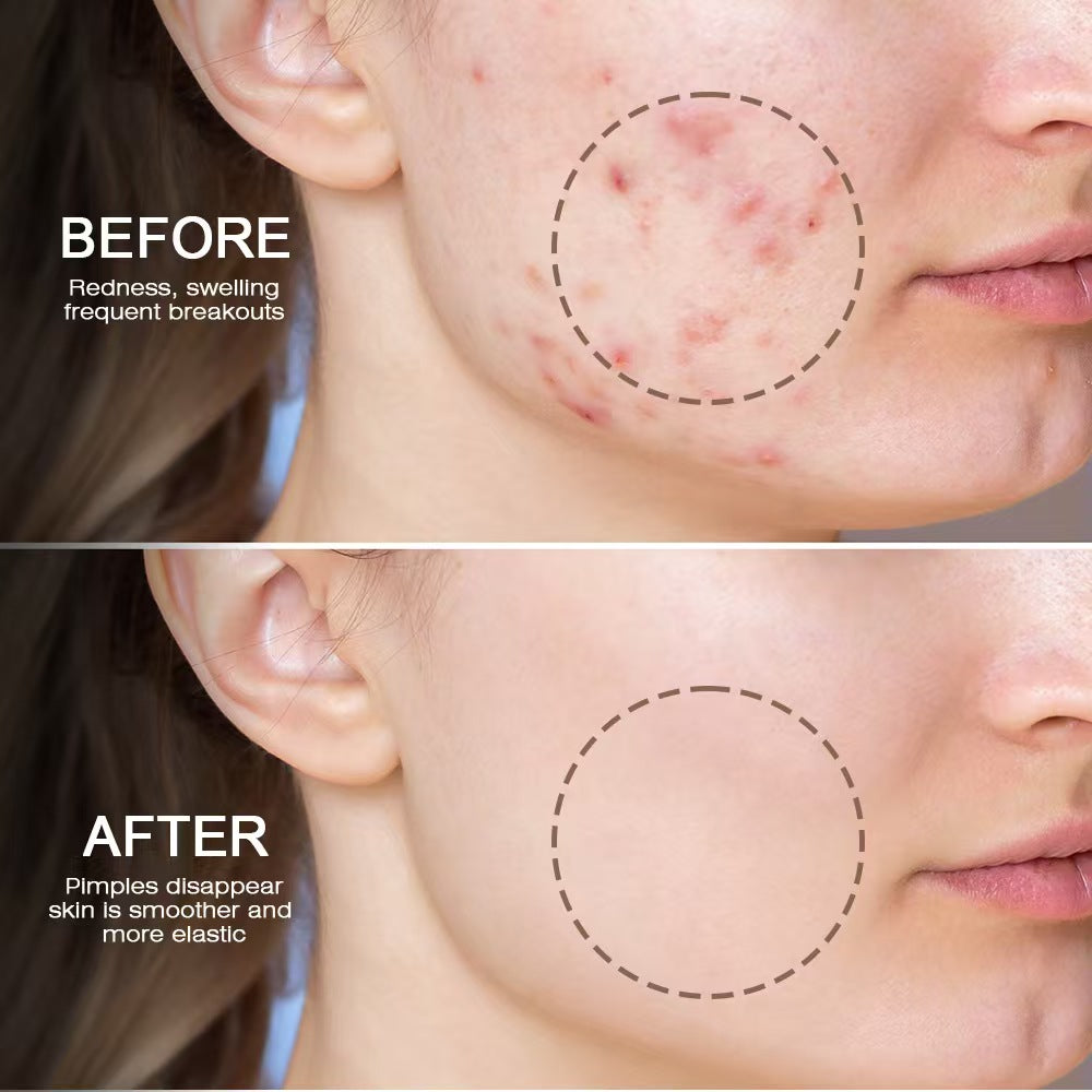 Snmifun - Bee Anti-Acne Gel (Original)